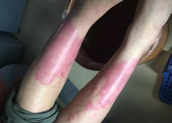 <b>30年牛皮癣患者氢沐浴感受（有图有真相）</b>