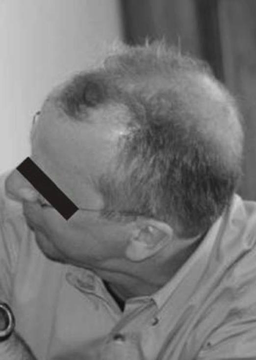 氢气对慢性疲劳综合征的神奇效果如何？