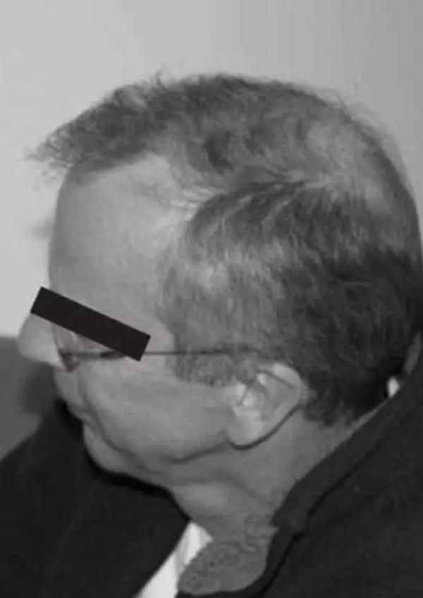 氢气对慢性疲劳综合征的神奇效果如何？