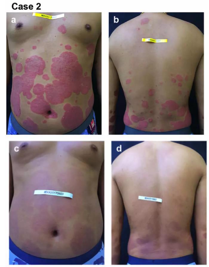 研究详解：氢气泡浴能有效改善牛皮癣