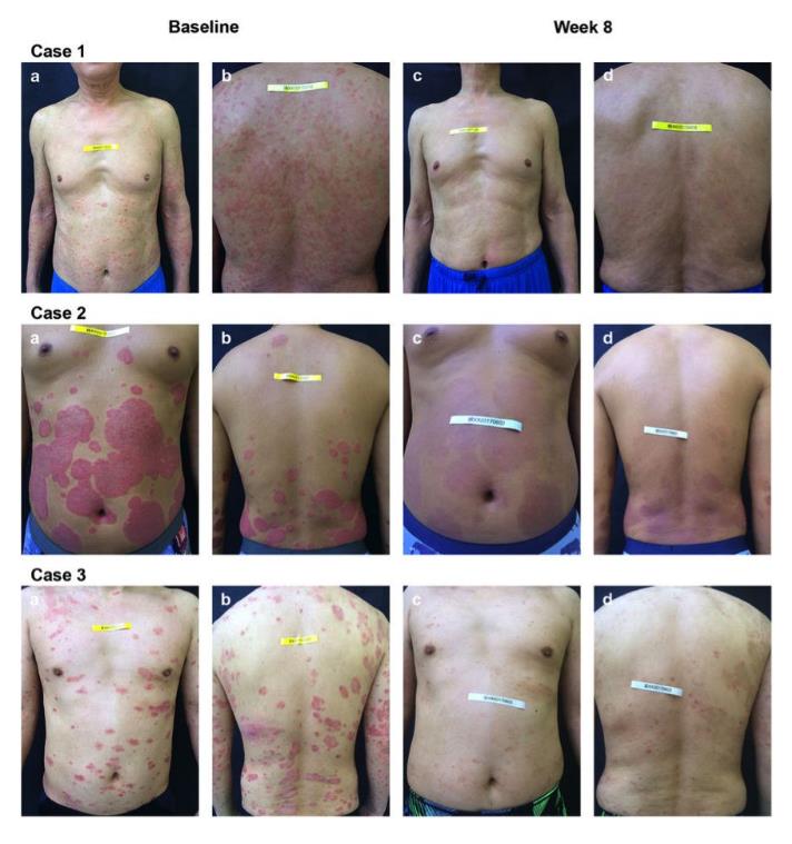 研究详解：氢气泡浴能有效改善牛皮癣