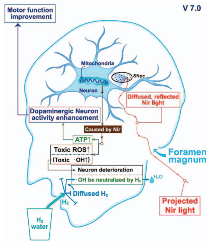 氢水改善帕金森【临床】