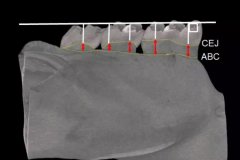 博天堂在线水对牙龈氧化应激和牙槽骨吸收的预防作用