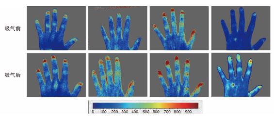 吸入氢氧混合气促进手部皮肤血流吸入氢氧混合气后，志愿者手背部皮肤血流明显增加