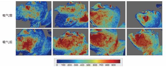 吸入氢氧混合气后，志愿者面部皮肤血流明显增加