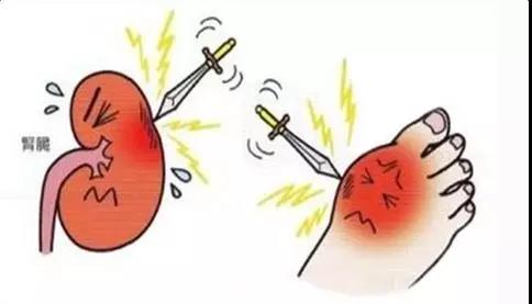 而且尿酸一高，就会在关节、韧带和肾脏等等地方形成结晶沉积下来